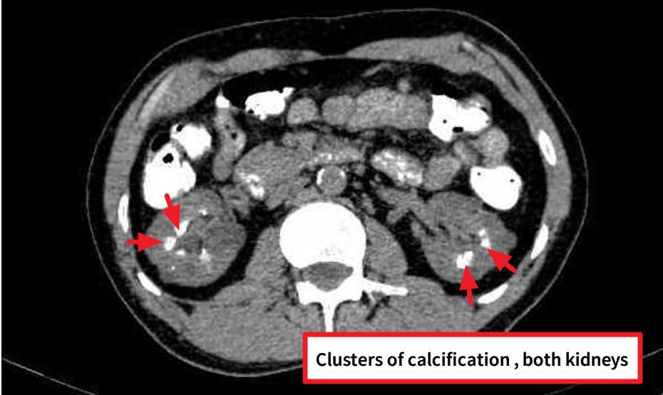 Medullary nephrocalcinosis