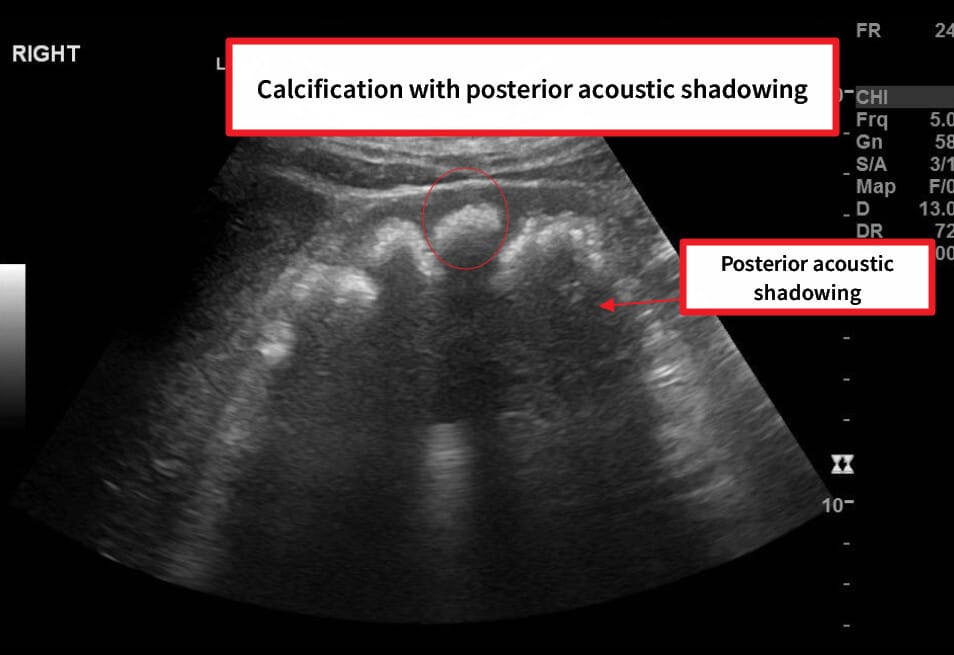 Medullary nephrocalcinosis