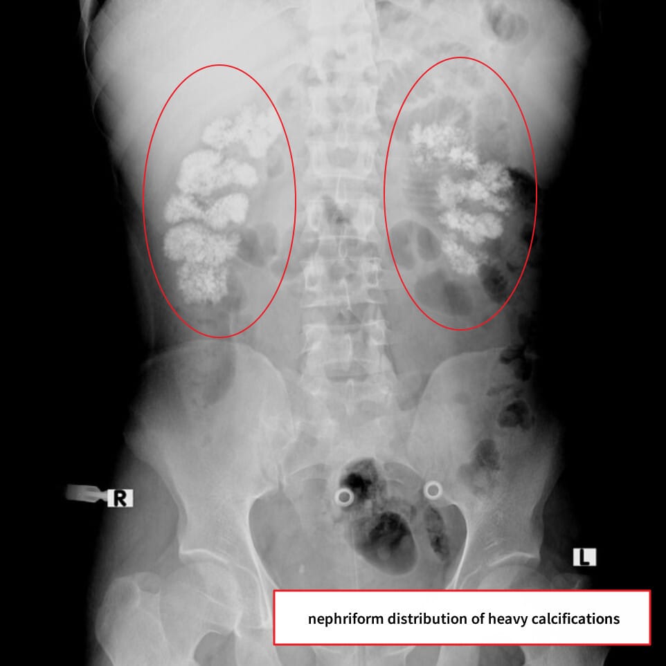 Medullary nephrocalcinosis