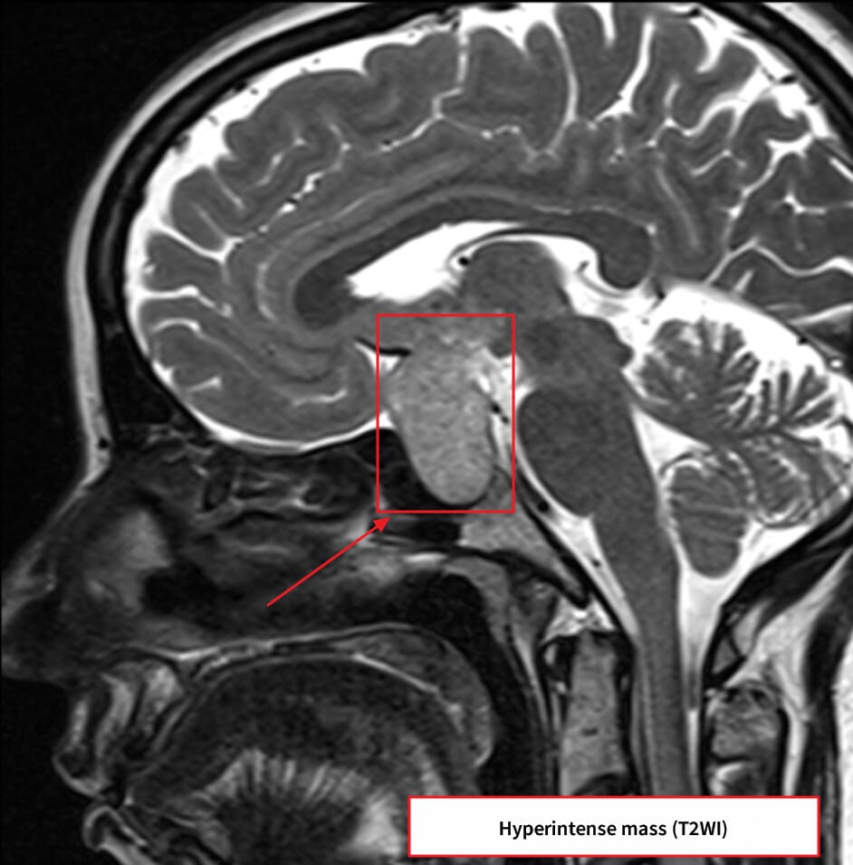 비기능성 뇌하수체 선종 (Non-functioning Pituitary Adenoma)