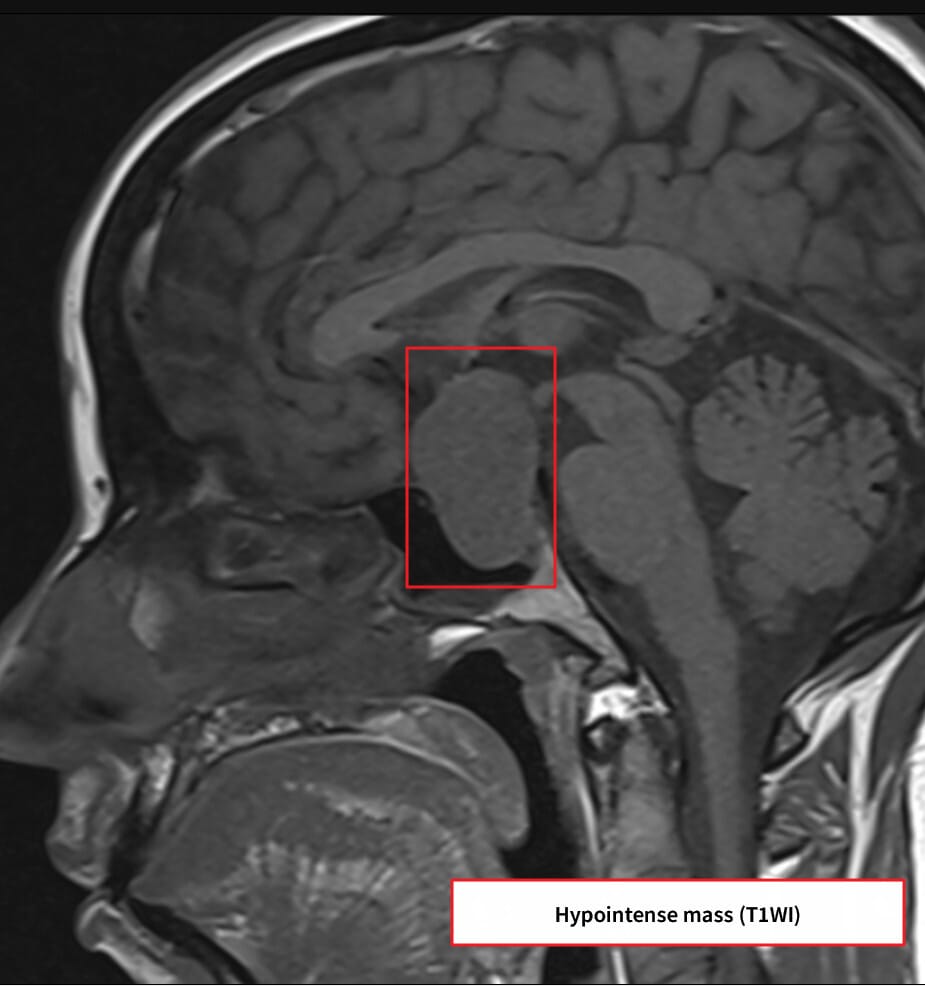 비기능성 뇌하수체 선종 (Non-functioning Pituitary Adenoma)