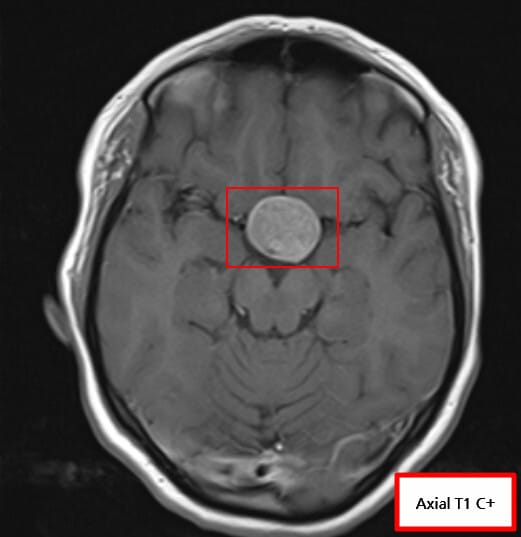 (Non-functioning Pituitary Adenoma)