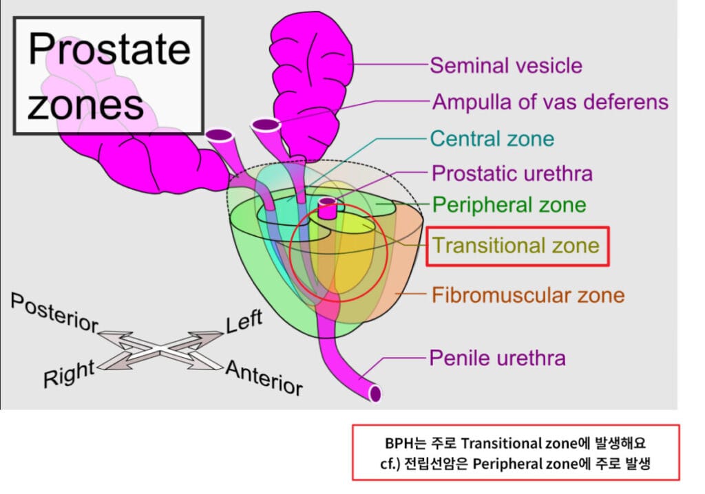 양성 전립선 비대증 (Benign Prostatic Hyperplasia, BPH)