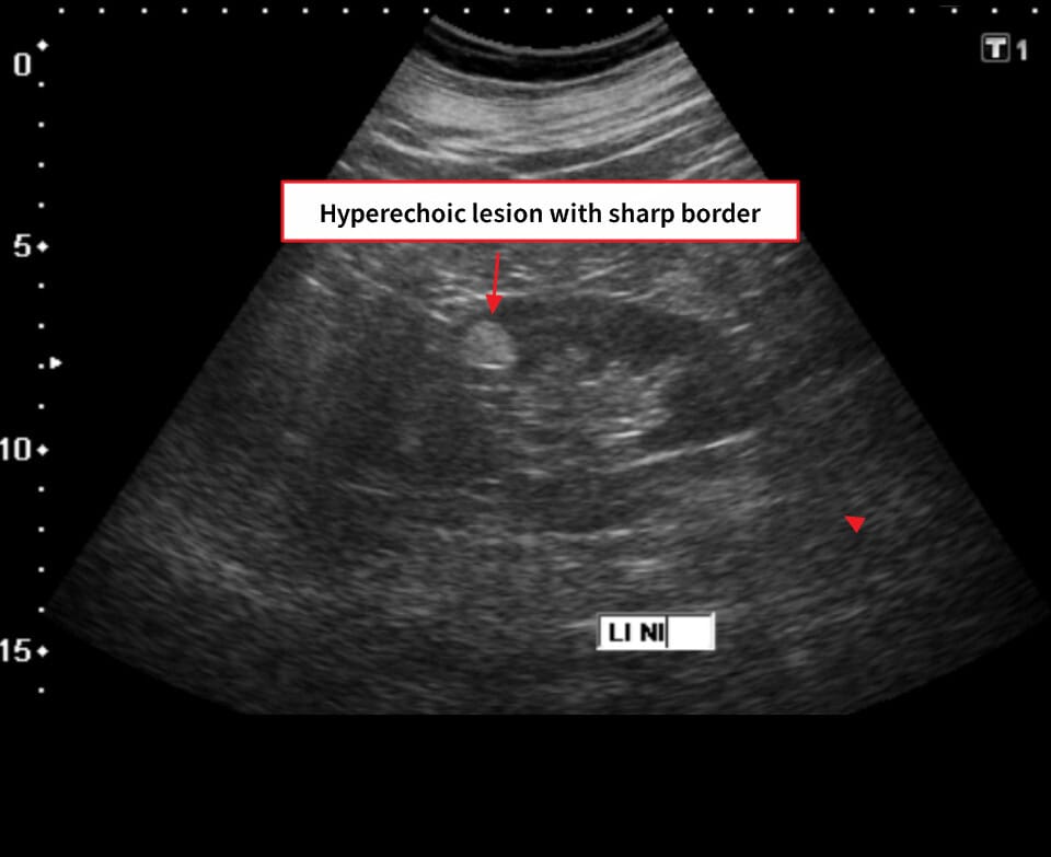 Renal Angiomyolipoma