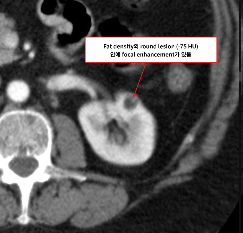 Renal Angiomyolipoma