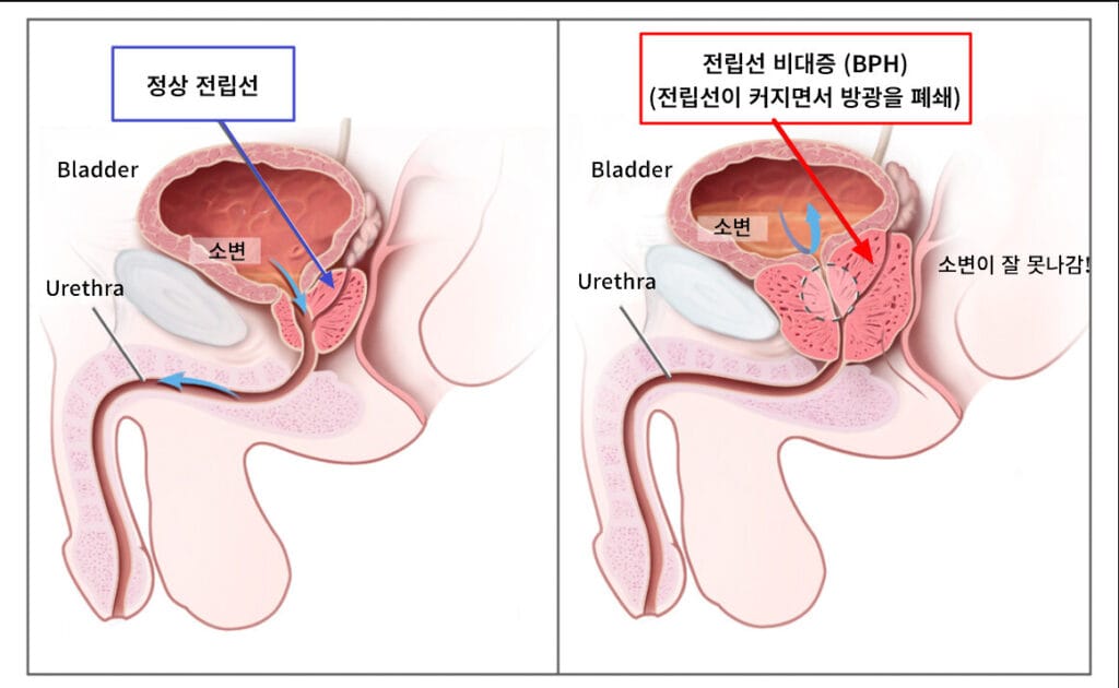 양성 전립선 비대증 (Benign Prostatic Hyperplasia, BPH)