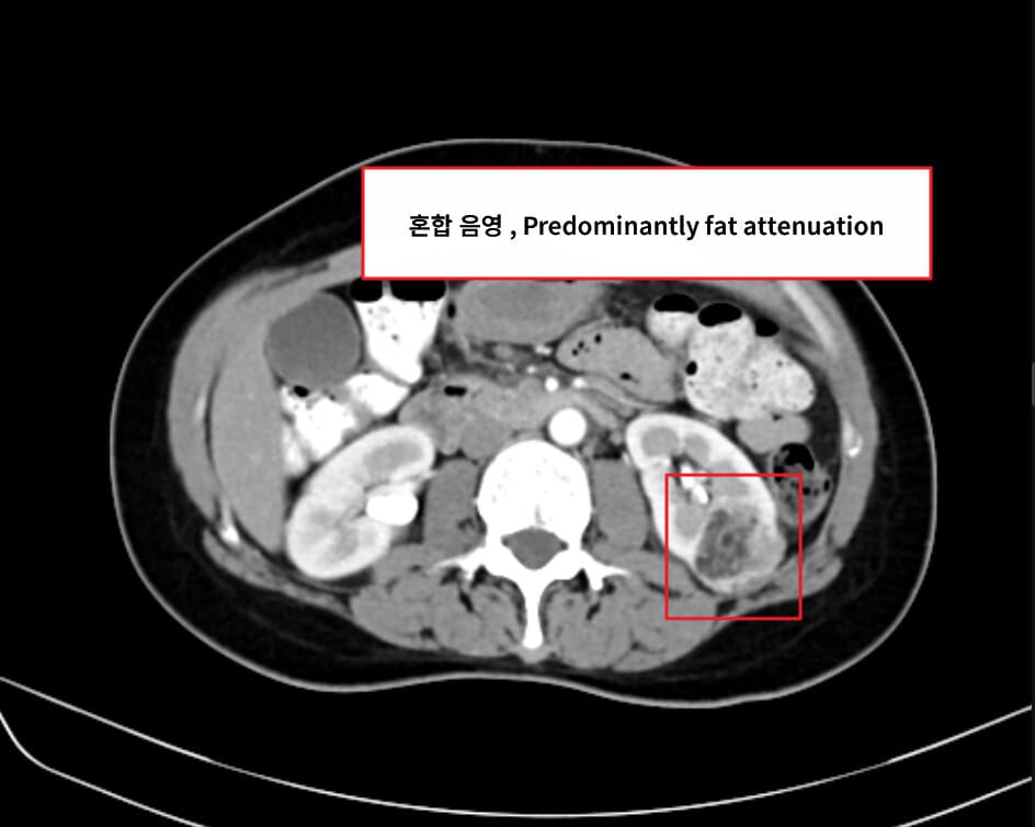 Renal Angiomyolipoma