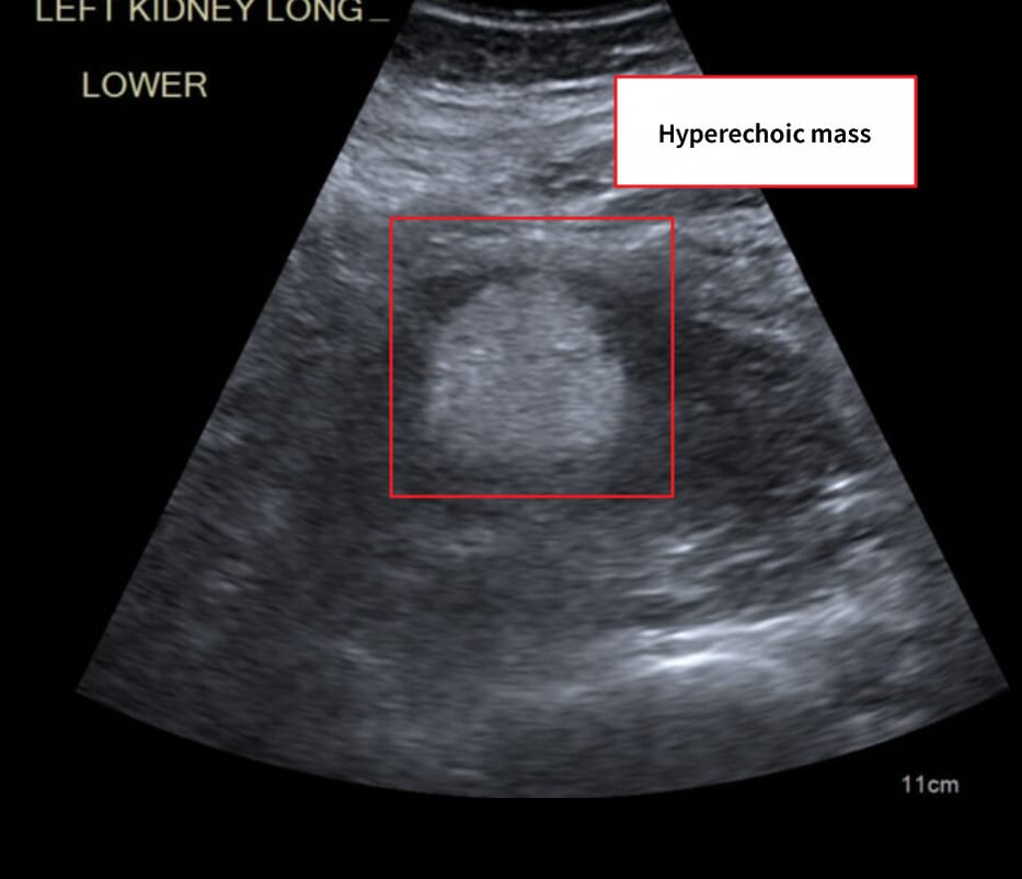 Renal Angiomyolipoma