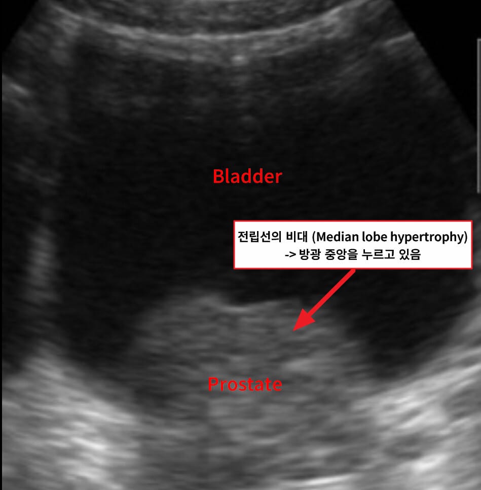 양성 전립선 비대증 (Benign Prostatic Hyperplasia, BPH)