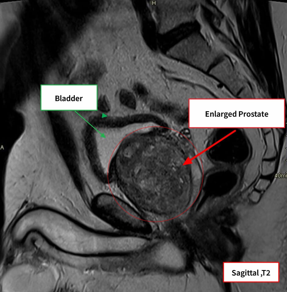 양성 전립선 비대증 (Benign Prostatic Hyperplasia, BPH)