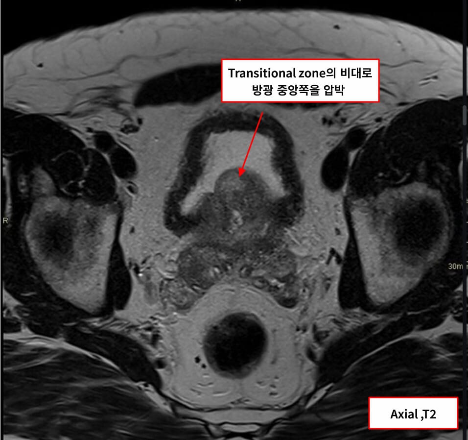 양성 전립선 비대증 (Benign Prostatic Hyperplasia, BPH)