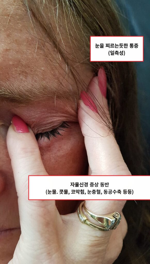 Cluster Headache