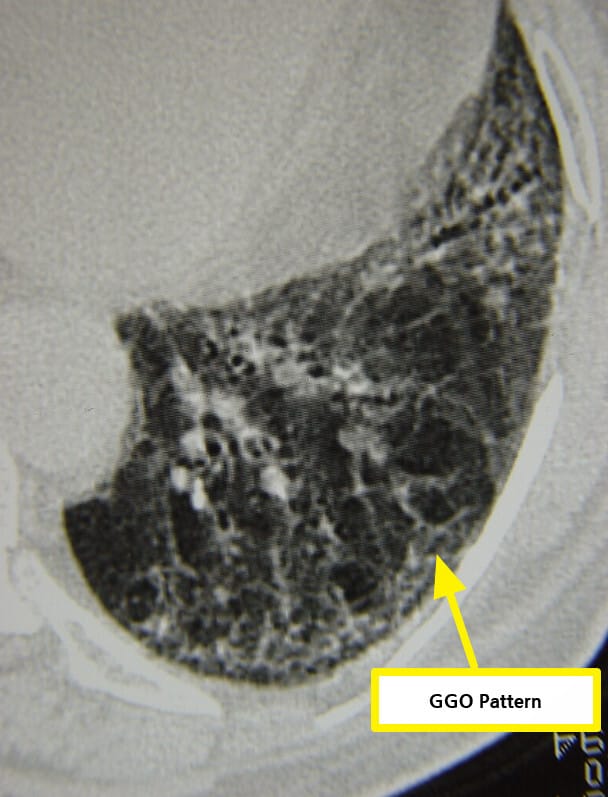 ILD associated with systemic sclerosis