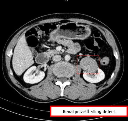 Renal Transitional Cell Carcinoma