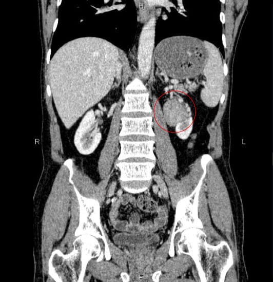 Renal Transitional Cell Carcinoma