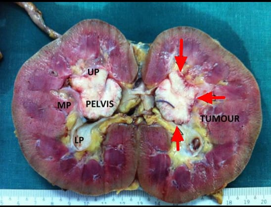 Renal Transitional Cell Carcinoma