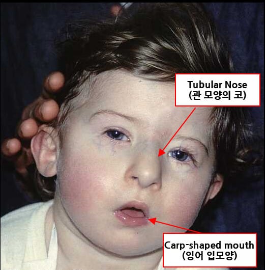 DiGeorge Syndrome