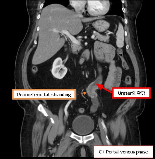 Renal Transitional Cell Carcinoma