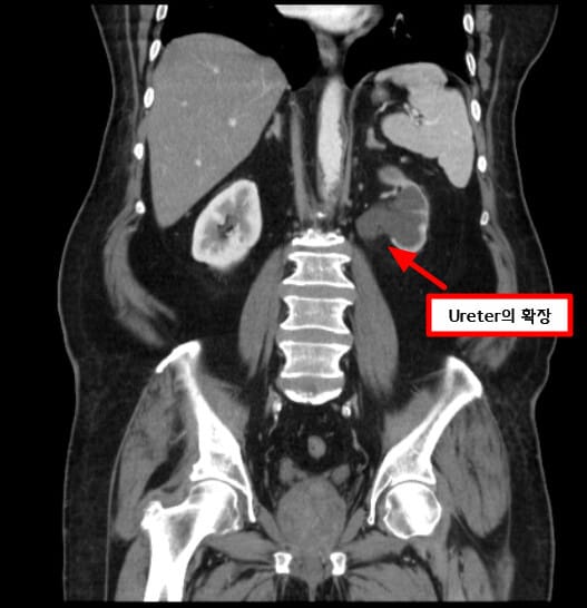 Renal Transitional Cell Carcinoma