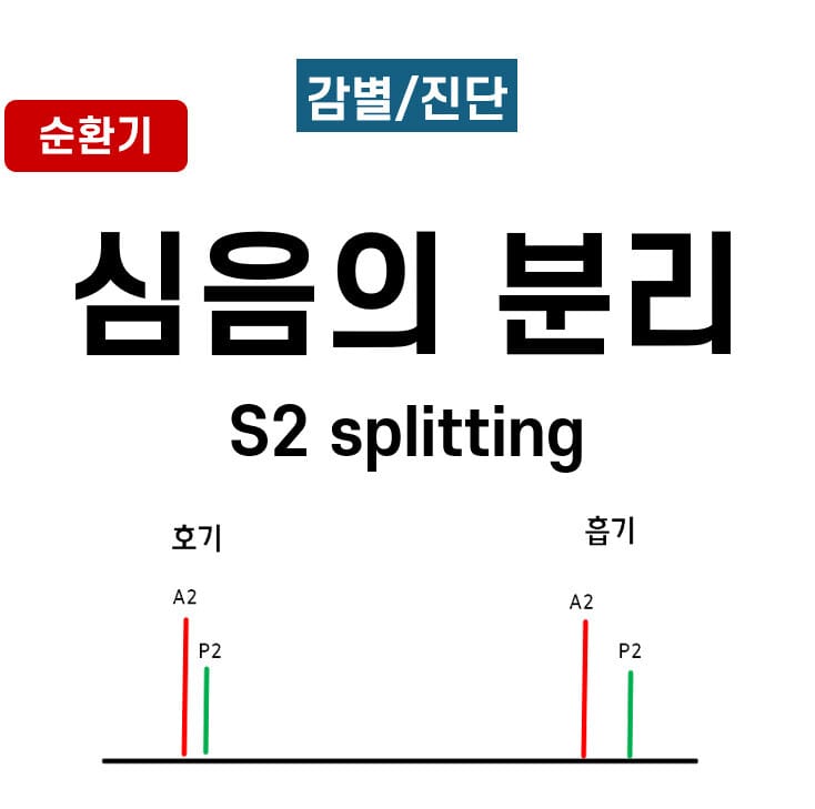 심음 분리 (S2 Splitting)