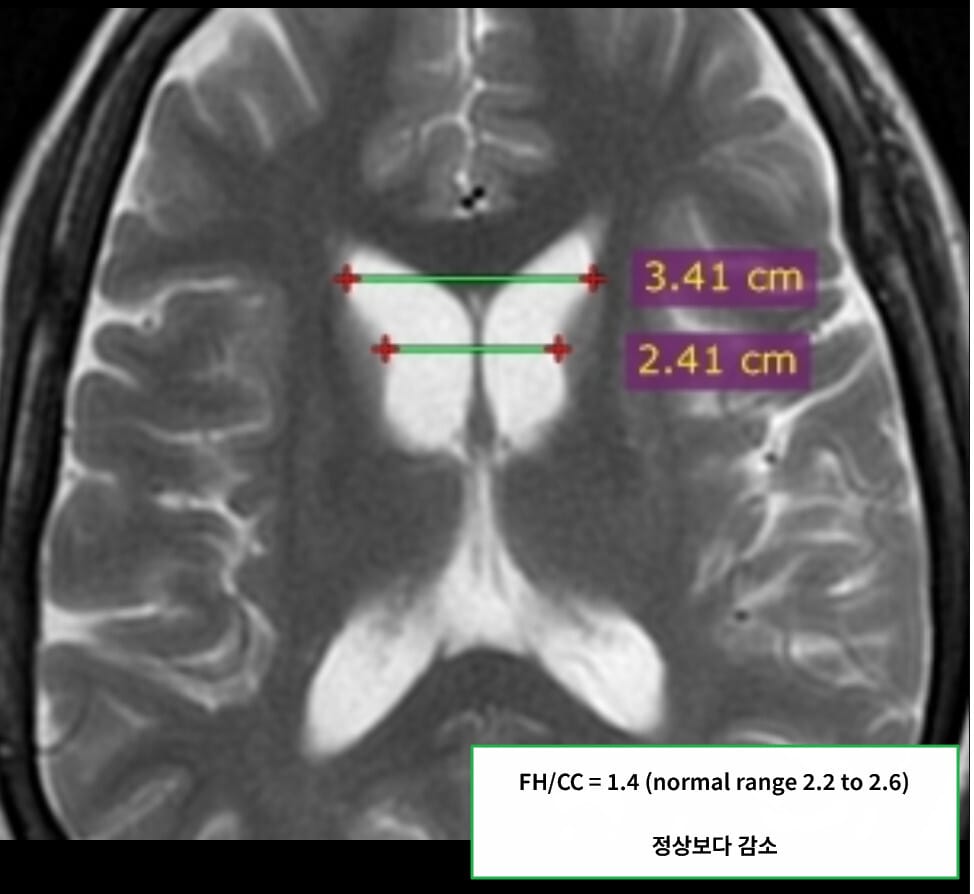헌팅턴병 (Huntington’s Disease)