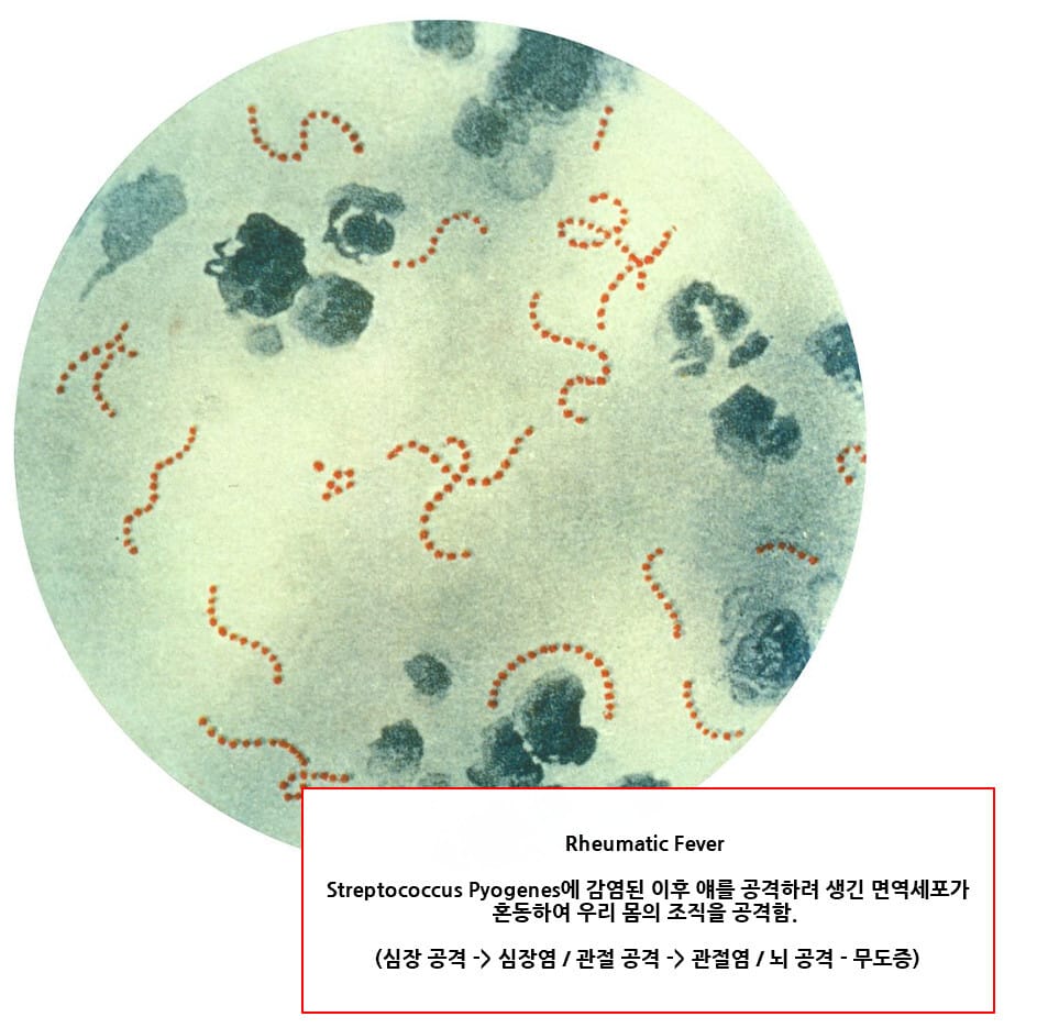 류마티스열 (Rheumatic Fever)