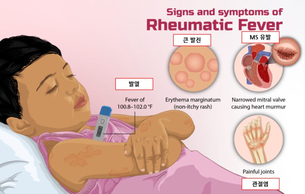 류마티스열 (Rheumatic Fever)