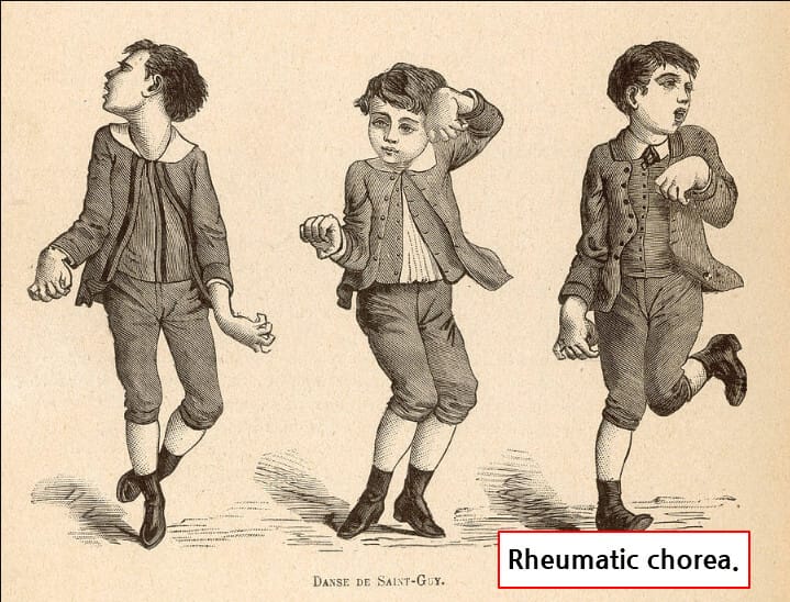 류마티스열 (Rheumatic Fever)