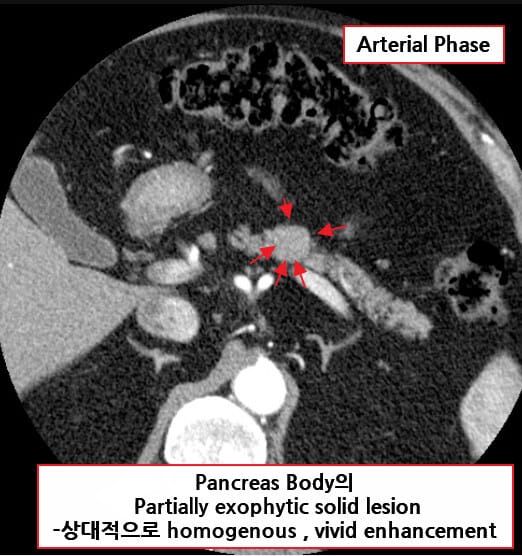 인슐린종 (Insulinoma)