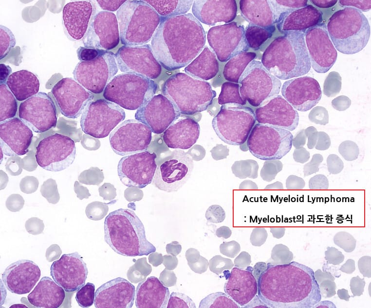 급성 골수성 백혈병 (Acute Myeloid Leukemia, AML)