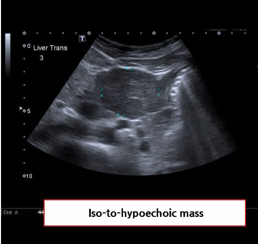 국소 결절성 과형성 (Focal Nodular Hyperplasia)