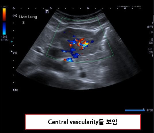 국소 결절성 과형성 (Focal Nodular Hyperplasia)