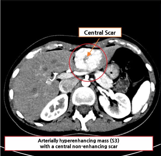 국소 결절성 과형성 (Focal Nodular Hyperplasia)