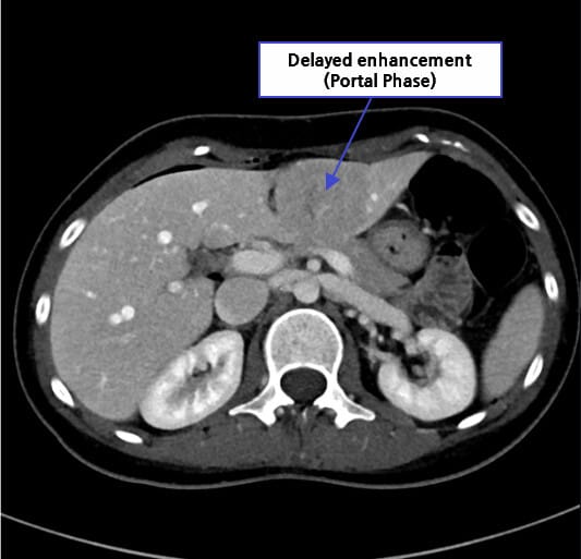 국소 결절성 과형성 (Focal Nodular Hyperplasia)