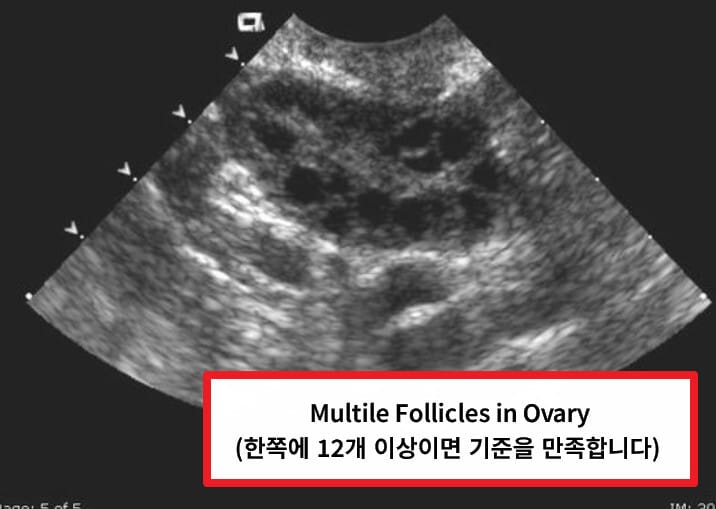 다낭성 난소 증후군 (Polycystic Ovary Syndrome, PCOS)