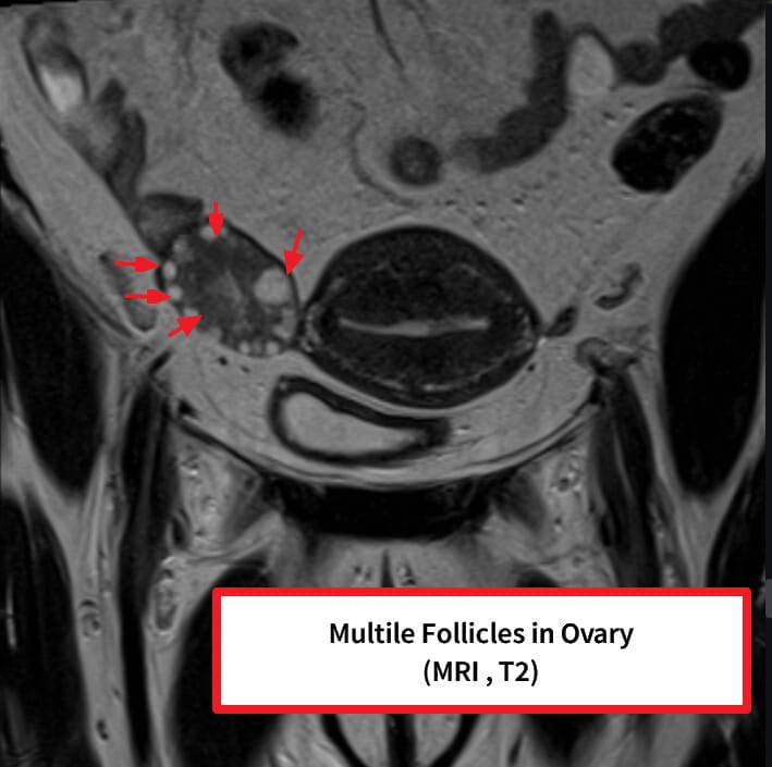 다낭성 난소 증후군 (Polycystic Ovary Syndrome, PCOS)