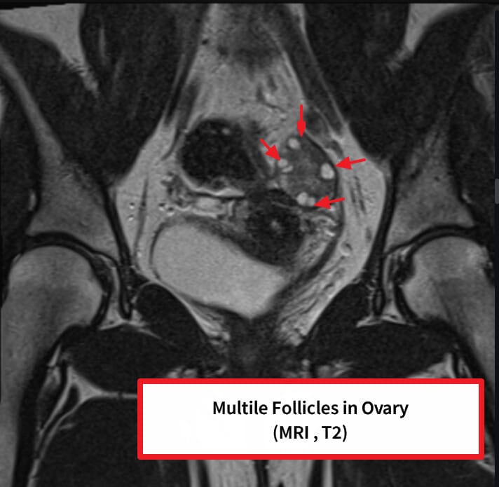 다낭성 난소 증후군 (Polycystic Ovary Syndrome, PCOS)