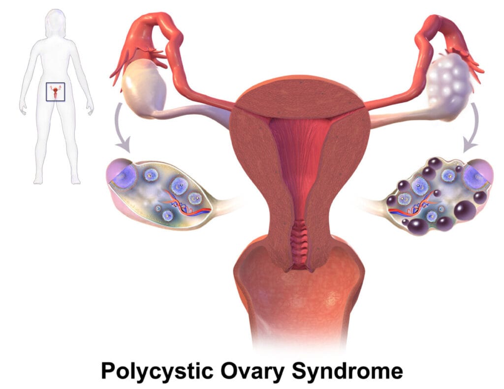 다낭성 난소 증후군 (Polycystic Ovary Syndrome, PCOS)