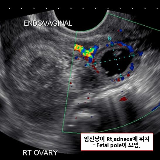 자궁외임신 (Ectopic Pregnancy)