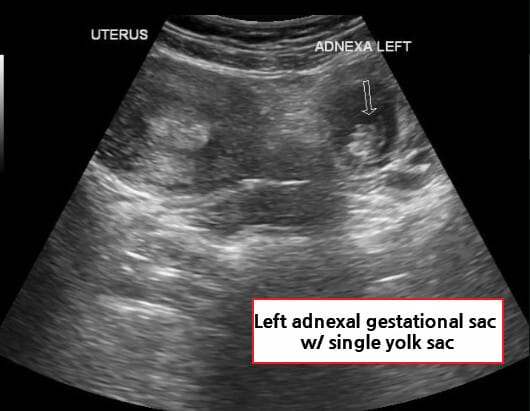 자궁외임신 (Ectopic Pregnancy)
