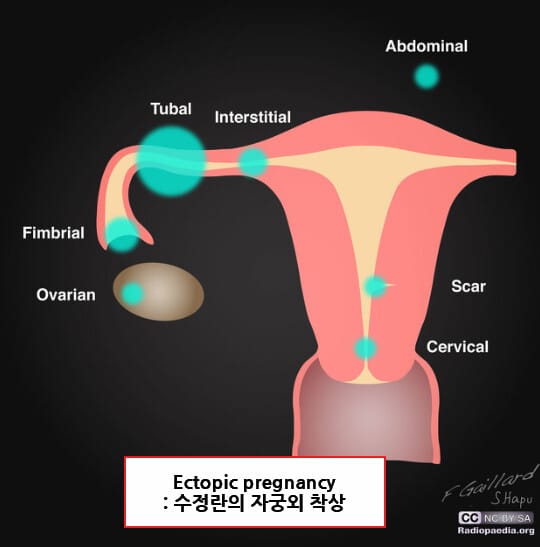 자궁외임신 (Ectopic Pregnancy)