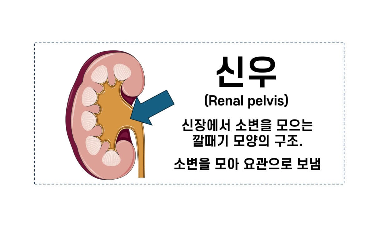 pyelonephritis