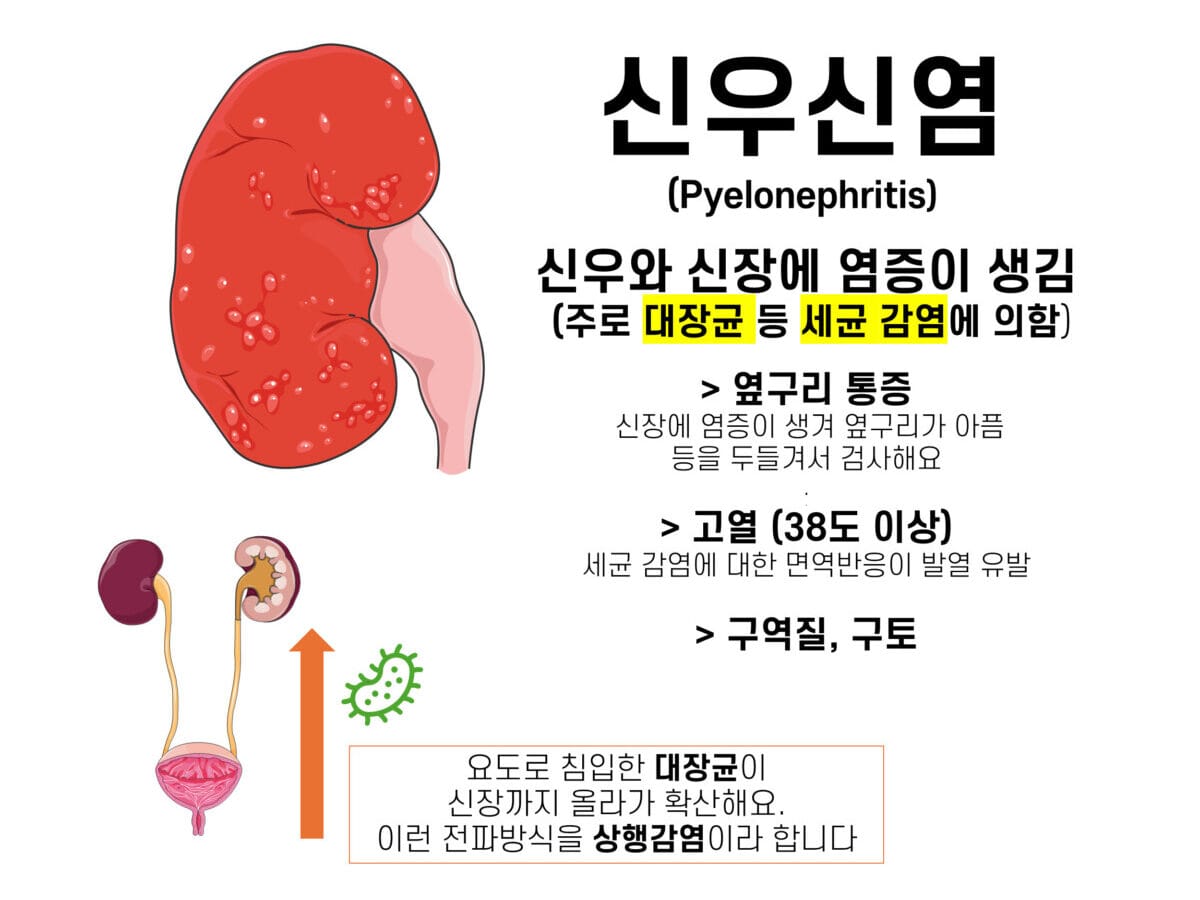 pyelonephritis