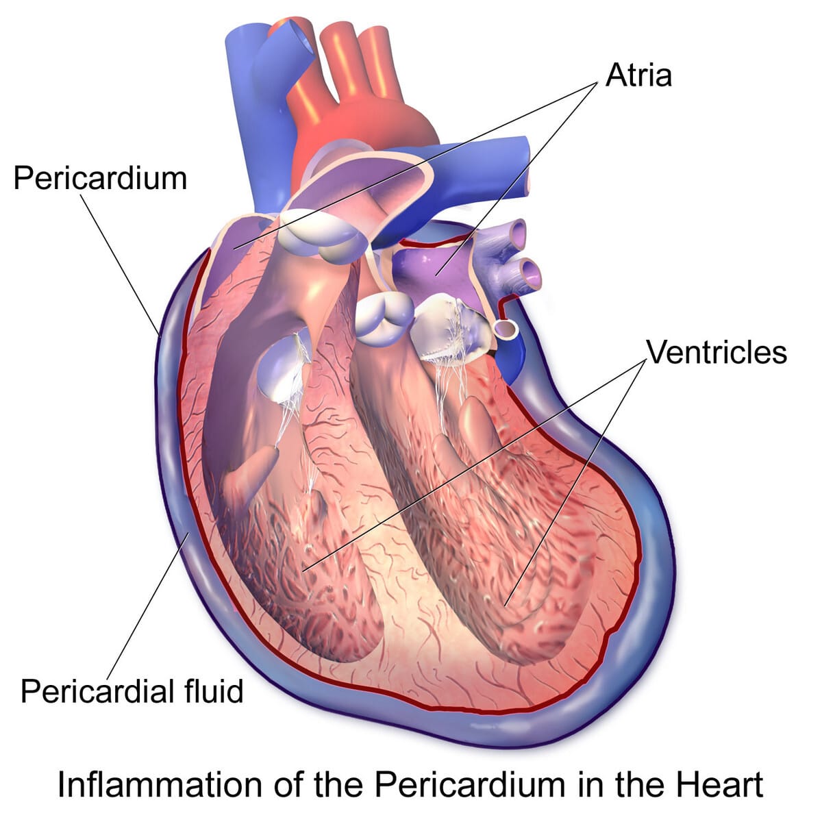 급성 심막염 (Acute Pericarditis) - 의학당