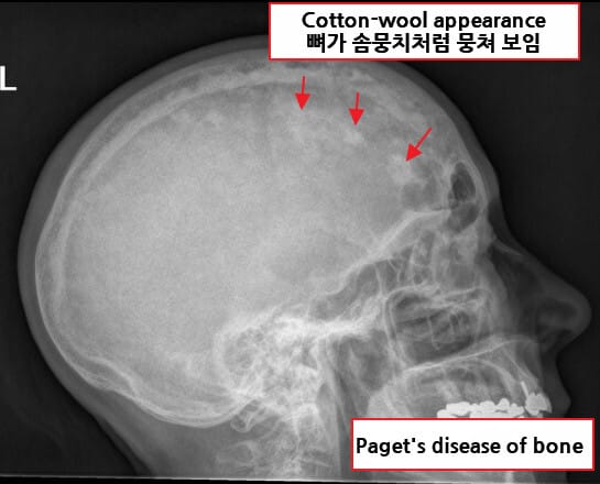 paget's disease