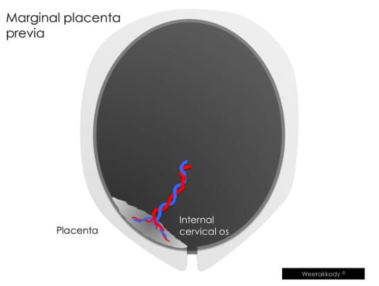 전치태반 (Placenta Previa)