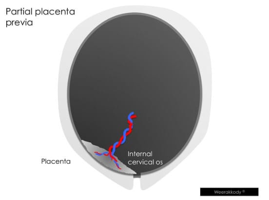전치태반 (Placenta Previa)