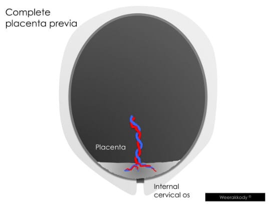 전치태반 (Placenta Previa)