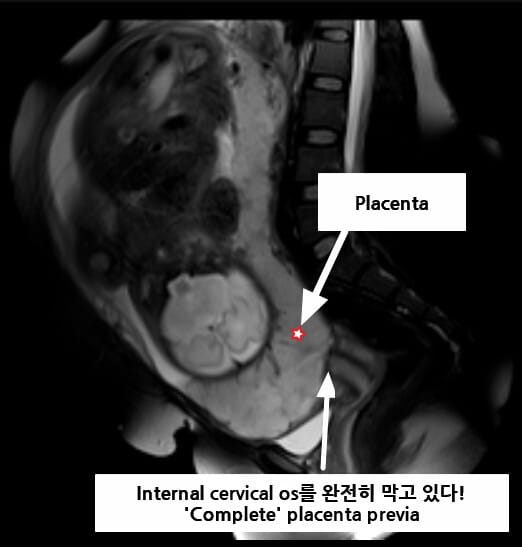 전치태반 (Placenta Previa)
