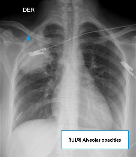 Pneumococcal pneumonia